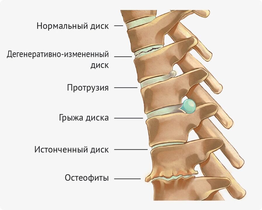 Disková deformita pro bederní osteochondrosis