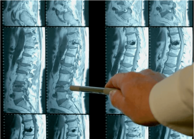 Odrůdy osteochondrosy v páteři