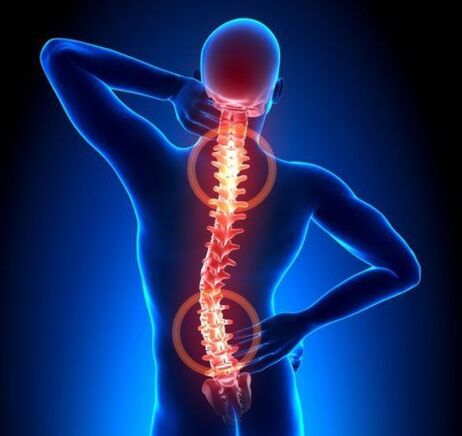 Osteochondroza páteře
