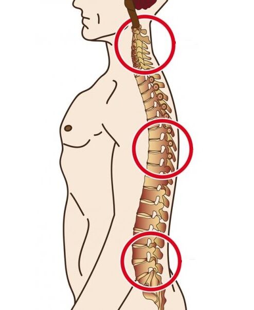 páteřní oddělení, ve kterých dochází k osteochondrosis