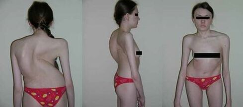 zakřivení páteře v důsledku osteochondózy
