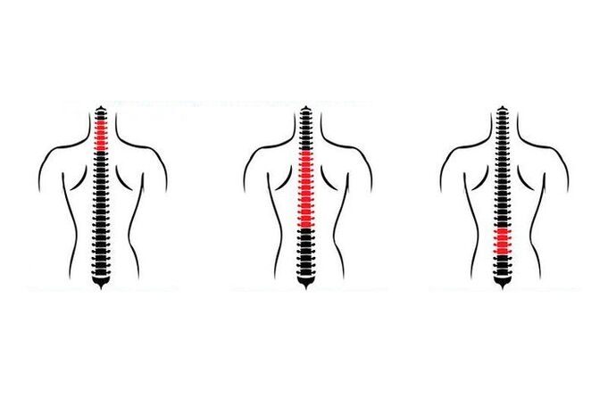 Jak se osteochondróza projevuje