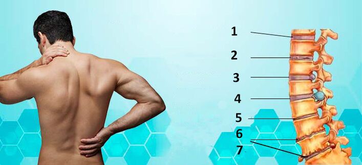 stádia vývoje osteochondrózy