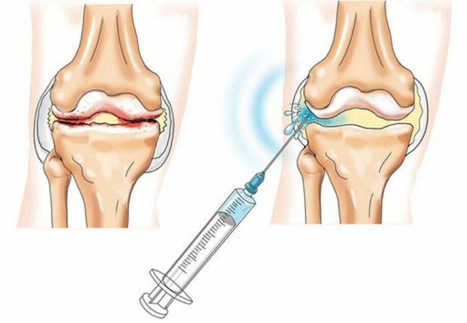 injekce do kolenního kloubu s artrózou