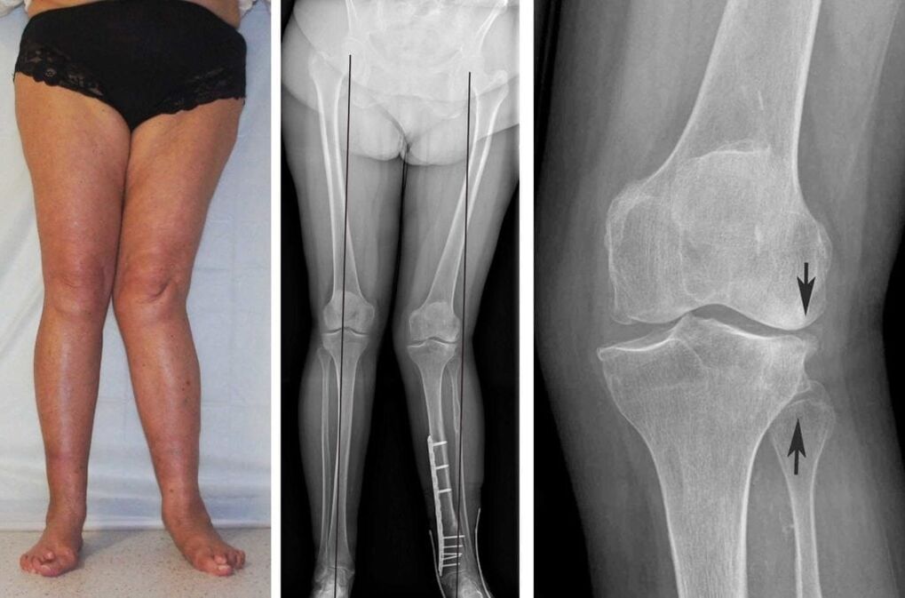Pokročilá artróza kolenních kloubů je dobře viditelná vizuálně i bez rentgenových snímků