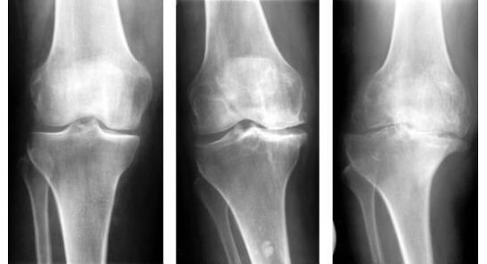 Povinným diagnostickým opatřením při identifikaci artrózy kolena je rentgen