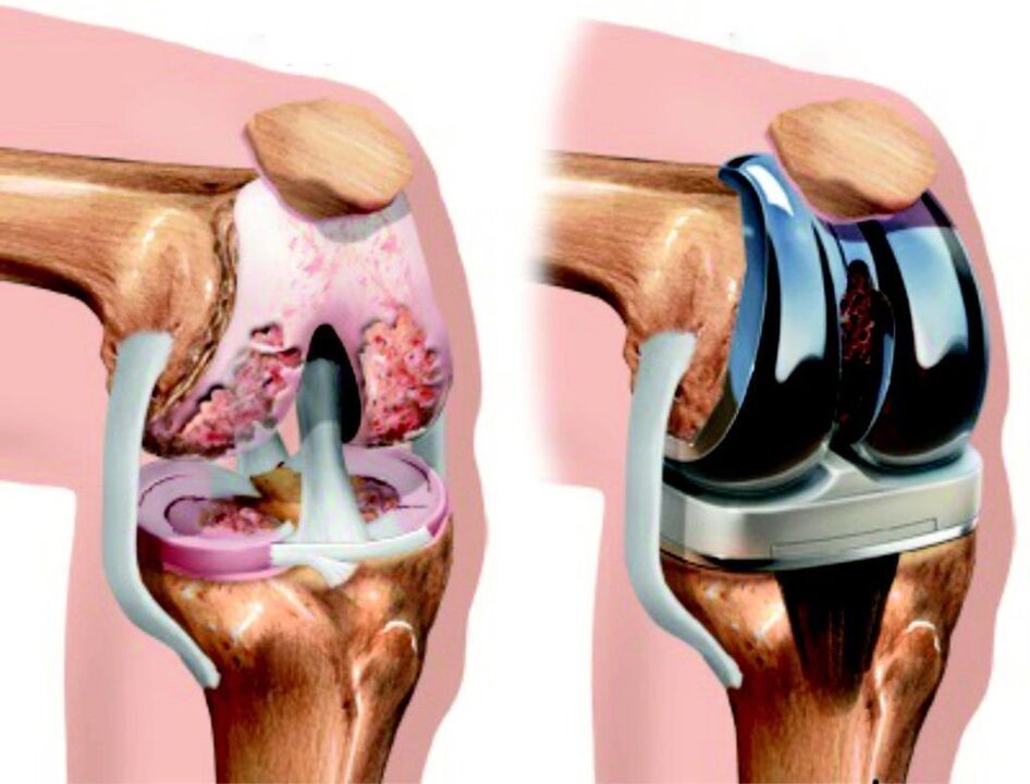 V případě totálního poškození kolenního kloubu artrózou je možné jej obnovit endoprotetikou